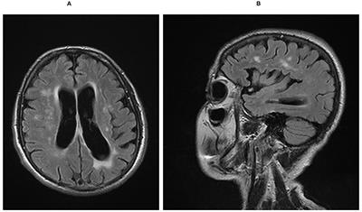 Case Report: Concomitant Alzheimer's and Lewy-Related Pathology Extending the Spectrum of Underlying Pathologies of Corticobasal Syndrome